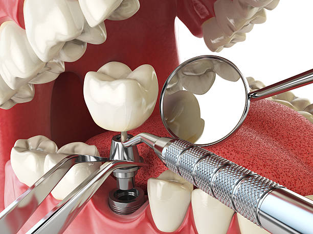 Best Emergency Denture Repair in Queen Creek, AZ